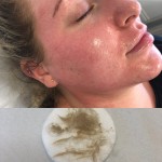 Before and after dermaplaning