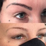 Eyebrow Removal