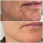Before and after RF Microneedling