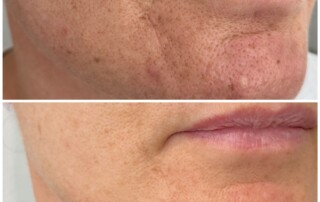 Before and after RF Microneedling