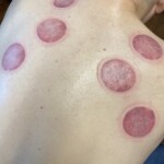 After Cupping