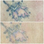 Healed after 1 session of tattoo removal