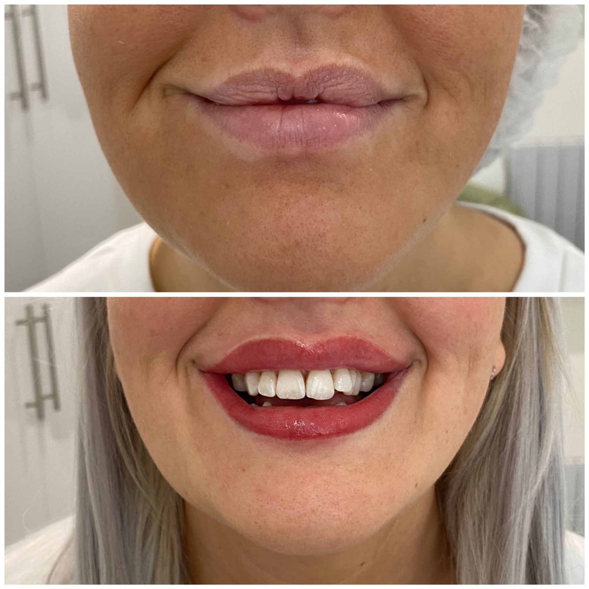 Permanent Lip Liner Before and After Photos - Ruth Swissa